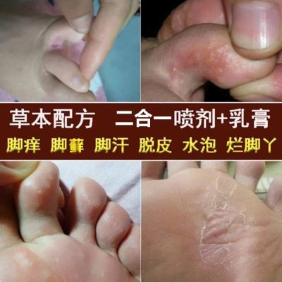 净癣肤王去脚气药喷剂脱皮水泡脚癣大腿内侧瘙痒抑菌草本止痒膏