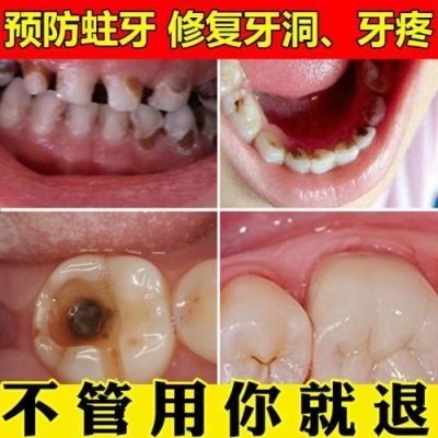 去牙疼牙痛喷剂去除牙周炎立可停牙痛宁蛀虫蛀牙上火牙龈肿痛