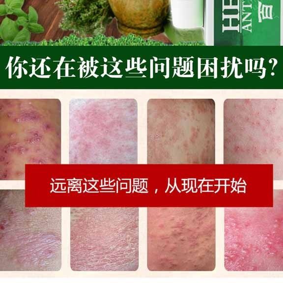 皮湿疹皮肤瘙痒癣止痒膏大腿内侧肛门阴囊痒抑菌乳膏