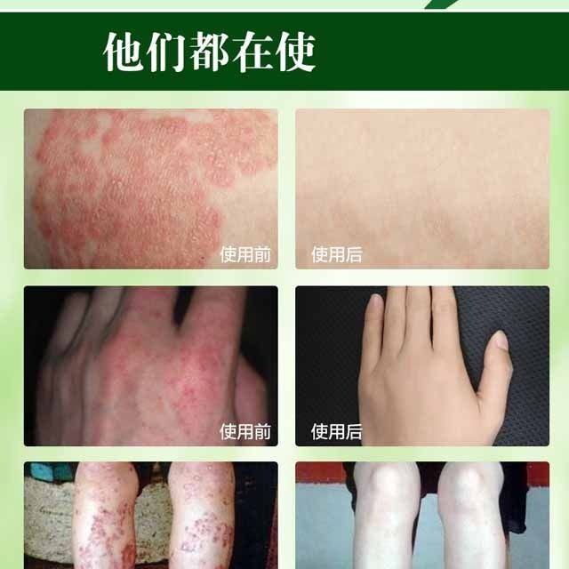 皮湿疹皮肤瘙痒癣止痒膏大腿内侧肛门阴囊痒抑菌乳膏