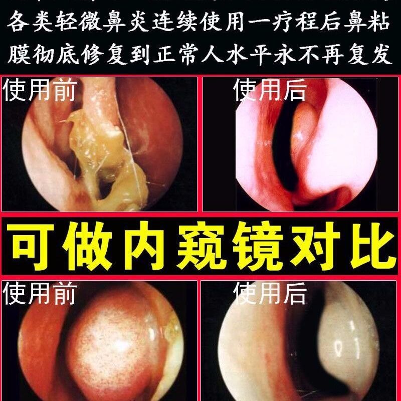 鼻炎膏特效鼻息肉克星过敏性鼻炎喷剂喷雾鼻塞鼻甲肥大鼻窦炎苗医