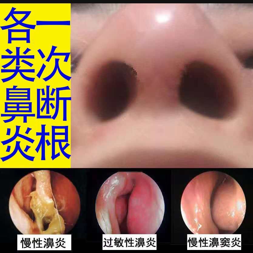 鼻炎膏特效鼻息肉过敏性流鼻涕克星喷剂治鼻甲肥大鼻窦炎四季苗家