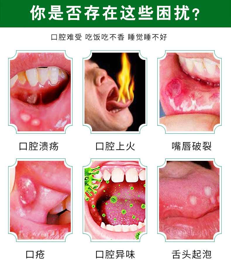 口腔溃疡喷剂治牙龈肿痛去口臭药口气清新剂漱口水咽喉炎牙疼喷雾