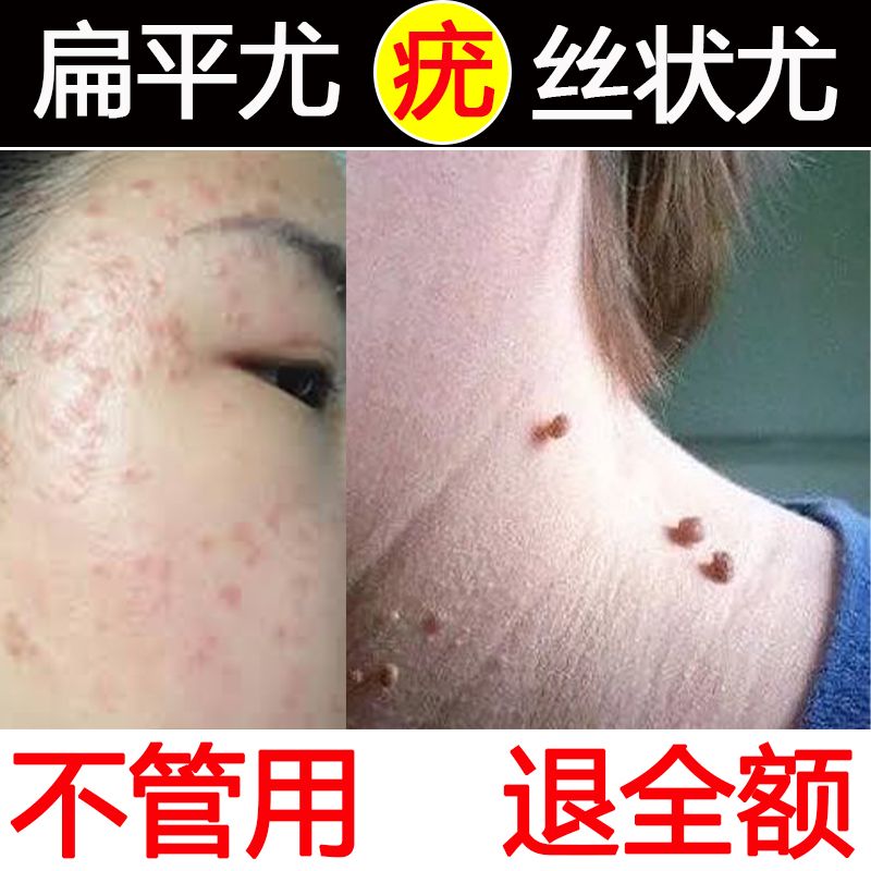 扁平尤疣去除膏面部肉痣凸痣寻常尤疣去尤疣灵肉粒丝状猴子跖尤疣