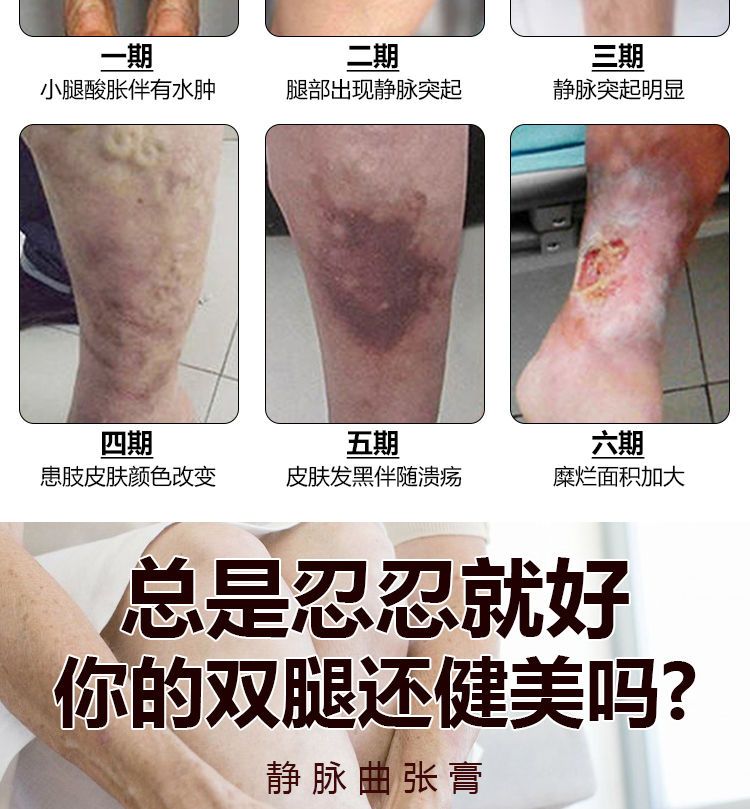 【不去全赔】静脉曲张膏蚯蚓腿腿部红血丝青筋凸起老