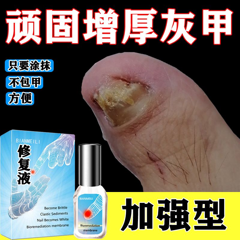 【拯救顽固灰甲】正品去灰甲增厚软甲膏去甲厚甲变色修复液