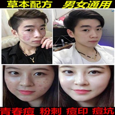 祛痘霜草本祛痘不留痕祛青春痘祛粉刺祛痘印平痘坑产品男女通用