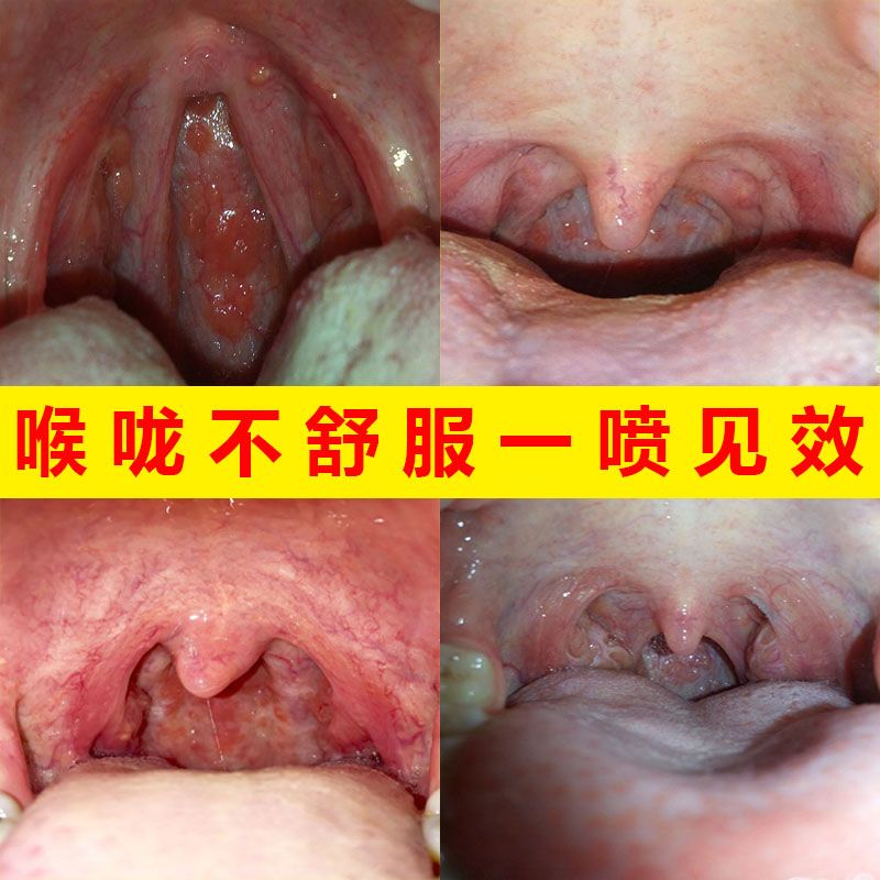 咽喉炎慢性咽炎特效茶喷剂异物感嗓子肿痛干痒干呕止咳化痰滤泡
