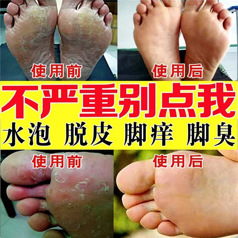 苗药治脚气膏脚气烂脚丫脚裂脚气药膏去脚气脚臭脚痒脚气药无激素