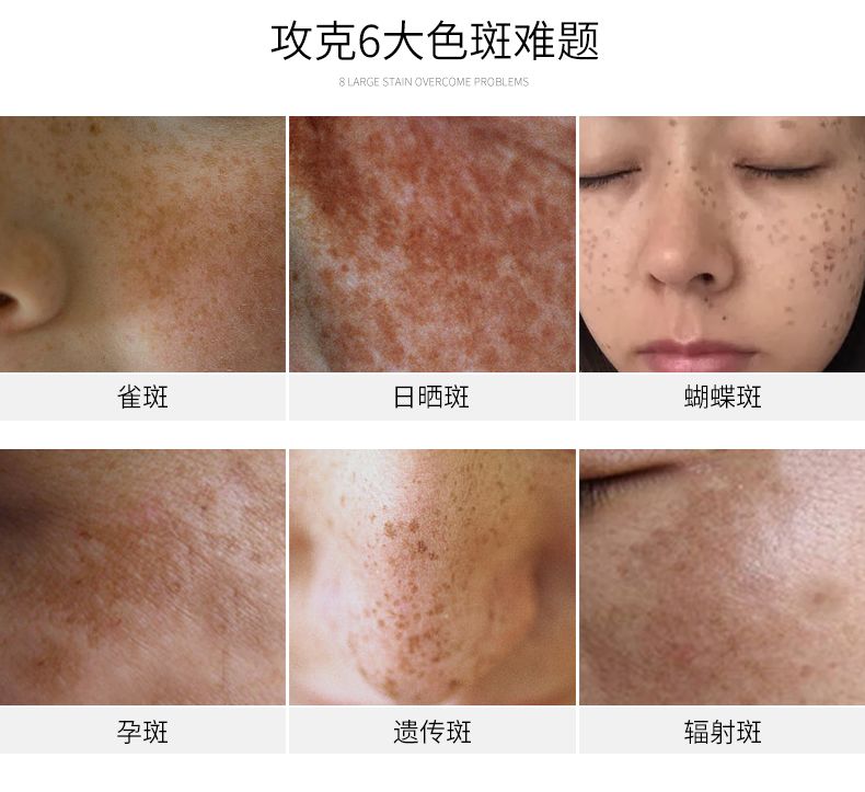 美白祛斑霜正品黄褐斑雀斑日晒斑色斑老年斑黑斑淡斑特效祛斑产品