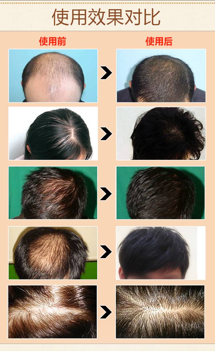 如何防脱发及生发密发方法 70