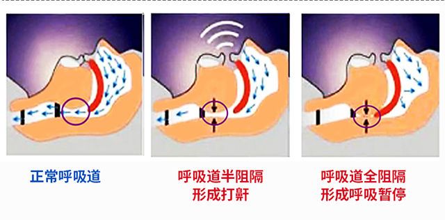 鼾立停打呼噜止鼾神器打呼噜药睡觉止鼾器打呼打鼾喷雾成人正品