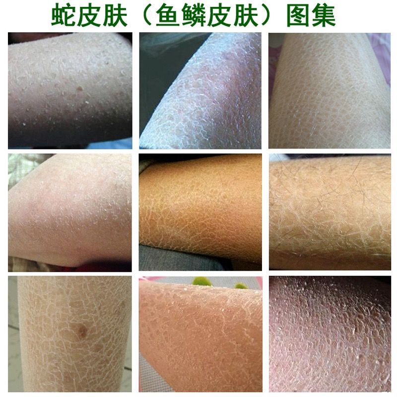 去皮肤鸡皮疙瘩的产品(去皮肤鸡皮疙瘩的产品有哪些)