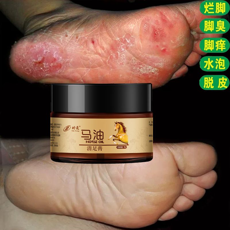 馬油腳氣膏去腳氣腳臭腳癢脫皮爛腳丫治腳氣藥腳氣噴劑止癢膏正品