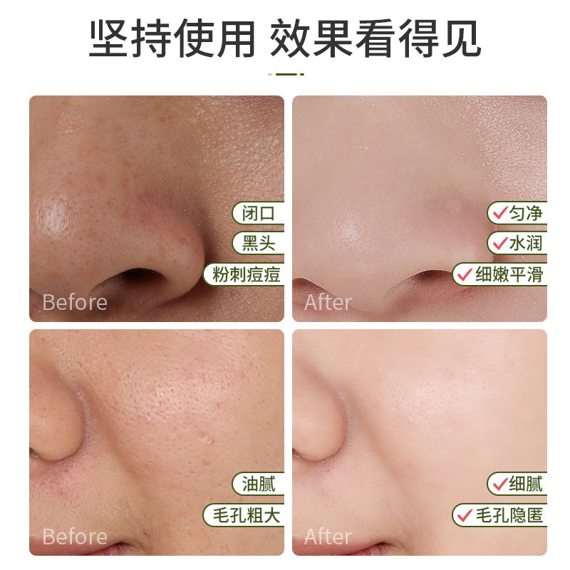 粉刺黑头闭口怎么区分 f2eb4616-1d7f-419d-8478-e3c30c61e04b.jpg