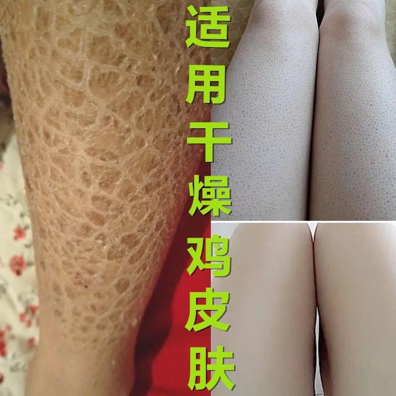 鸡皮疙瘩真的能掉下来吗(天生有鸡皮疙瘩的人是怎么弄掉的)