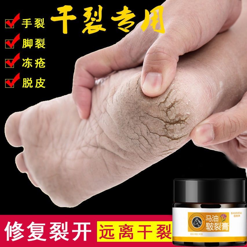 Chapped hands, cracked feet, cracked pain, bleeding, dry and rough skin, anti cracking and cracking hand cream, foot care