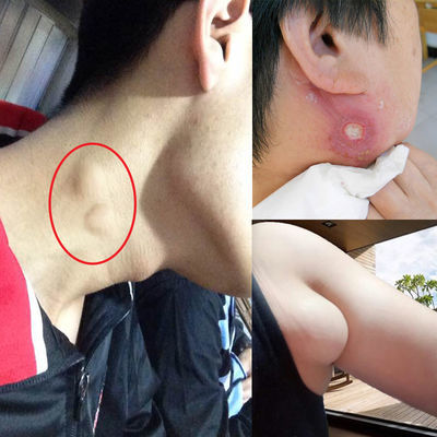【不满意退】副乳消除神器淋巴结肿大炎消贴颈部腋下淋巴结散结膏