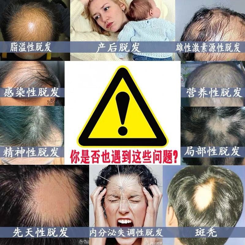 【真实生发案例】防脱生姜生发洗发水增发密发液控油去屑止痒露