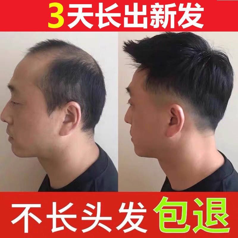 【真实生发案例】防脱生姜生发洗发水增发密发液控油去屑止痒露