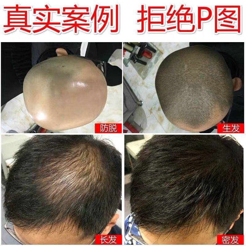 【真实生发案例】防脱生姜生发洗发水增发密发液控油去屑止痒露