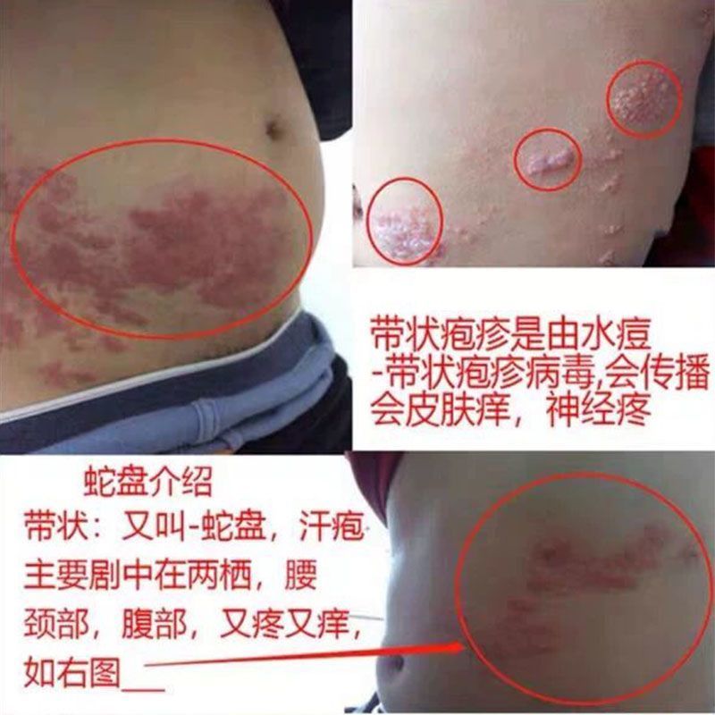 蛇盘疱克蛇盘疮带状疱疹飞蛇缠腰蛇胆疮蜘蛛疮糜烂水泡瘙痒乳膏剂