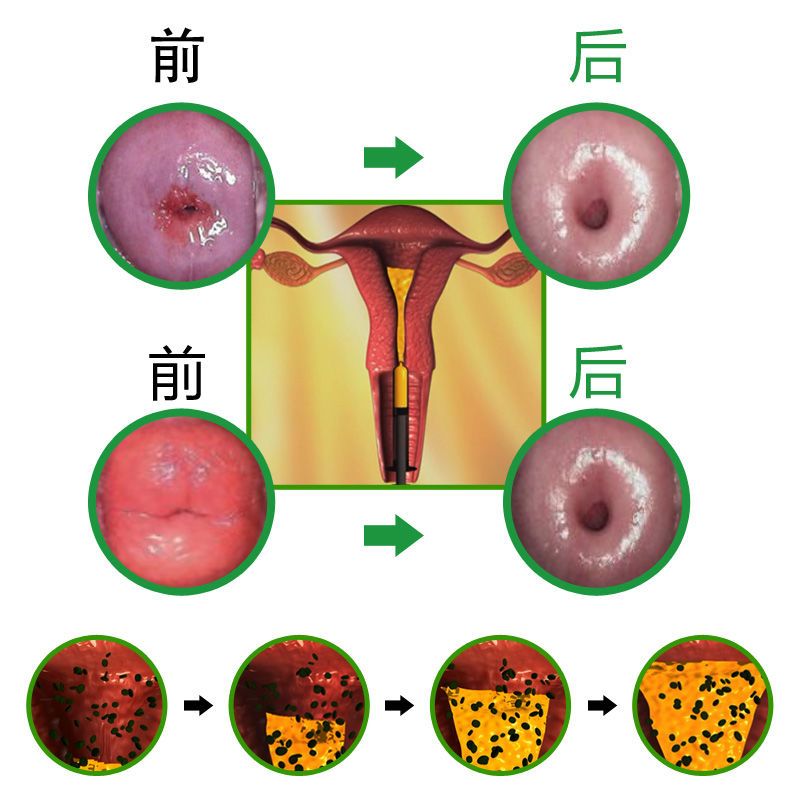 婦科凝膠宮頸糜爛用藥重度黴菌性陰道炎盆腔積液白帶異味婦科凝膠