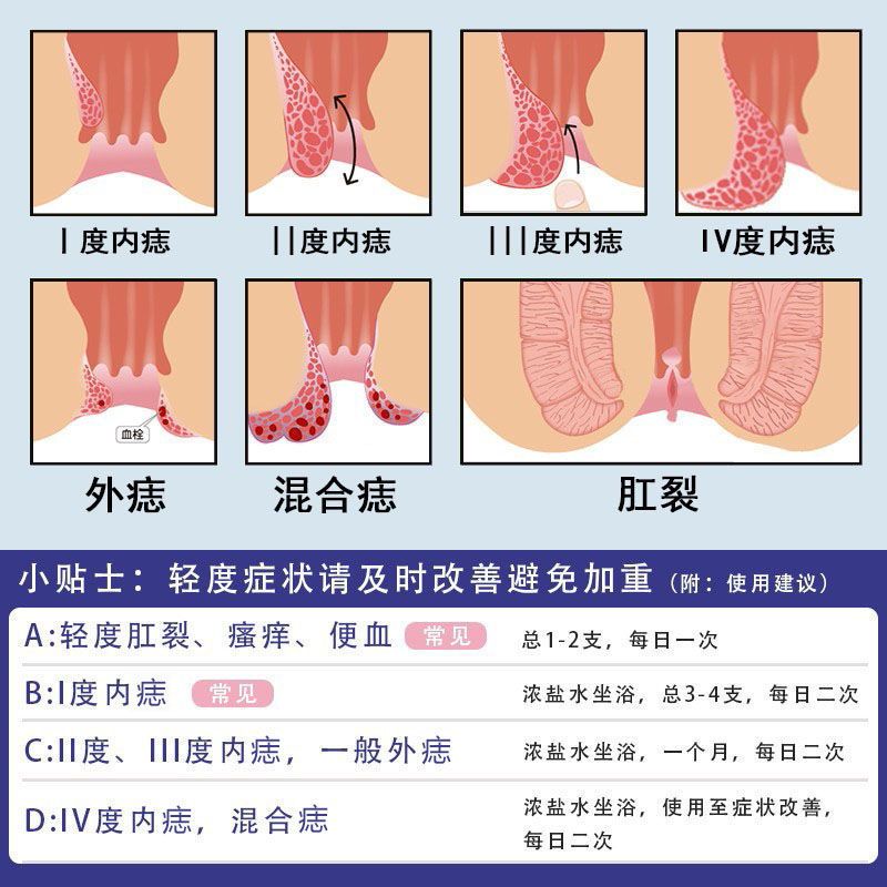 痔疮药膏根断痔膏治消肉球特效痔疮栓肛门便出血内痔外痔混合痔疮