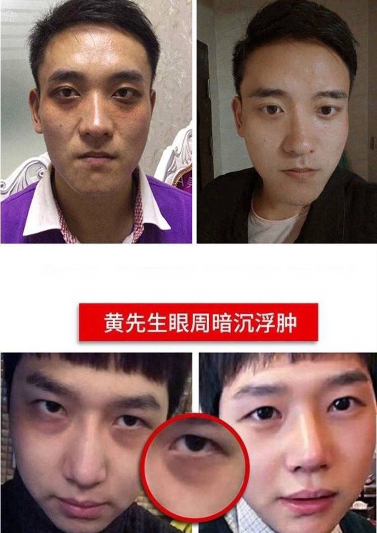 如何淡化黑眼圈眼纹 bbdd67ca-25e6-4243-afd6-d614d022836f.jpeg
