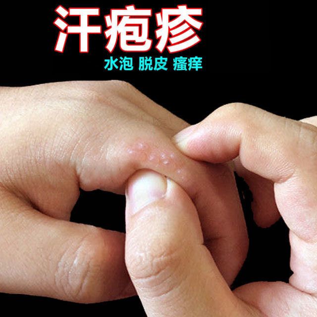 汗疱疹油鹅掌风药膏止痒药膏皮炎湿疹皮肤过敏瘙痒脱皮手上长水泡