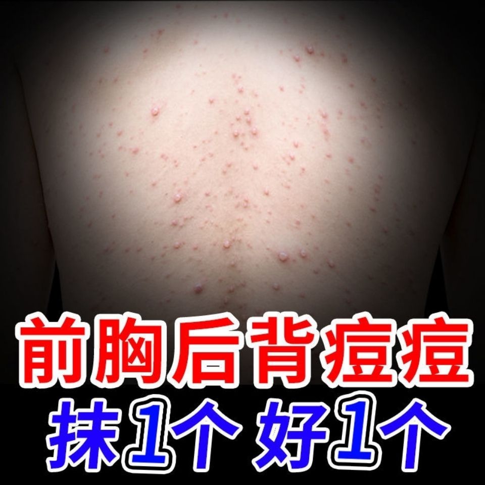 后背部祛痘除螨虫去背上身上胸口痘痘神器水 霜组合祛前胸粉刺
