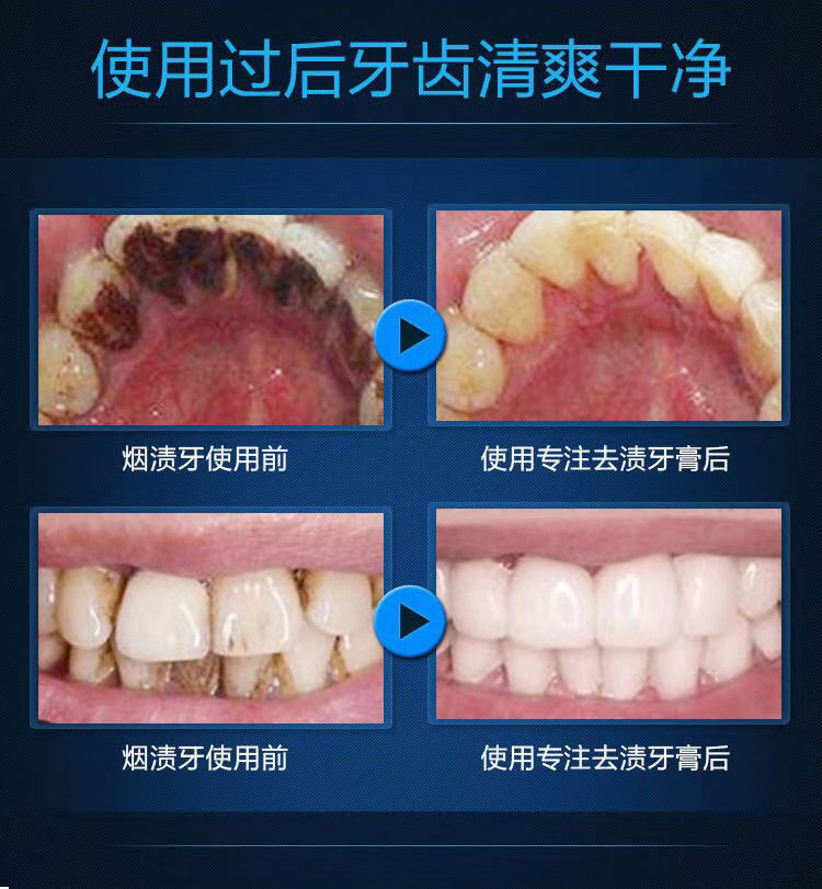牙贝健牙膏美白牙齿速效去黄牙烟渍牙垢牙结石洗牙神器清新除口臭