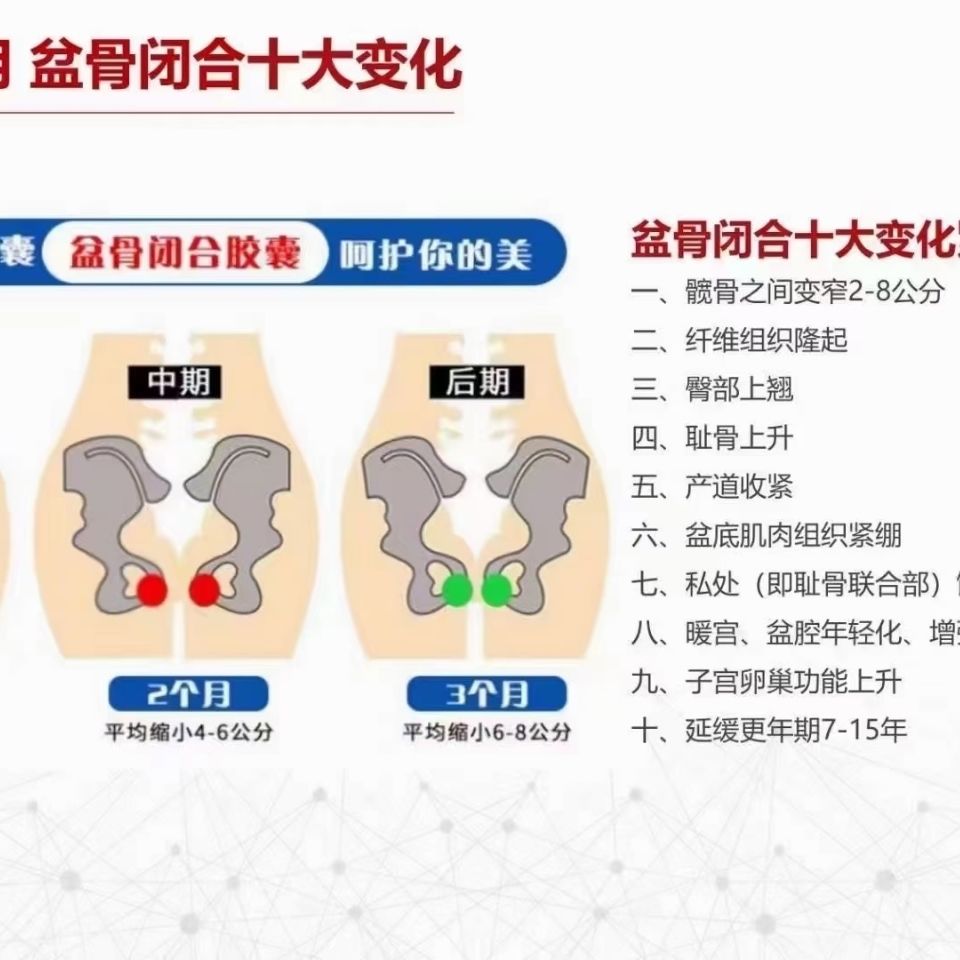 盆骨闭合胶囊修复盆肌底矫正体型收紧臀胯部骨盆前倾妇科产后修复 虎窝拼