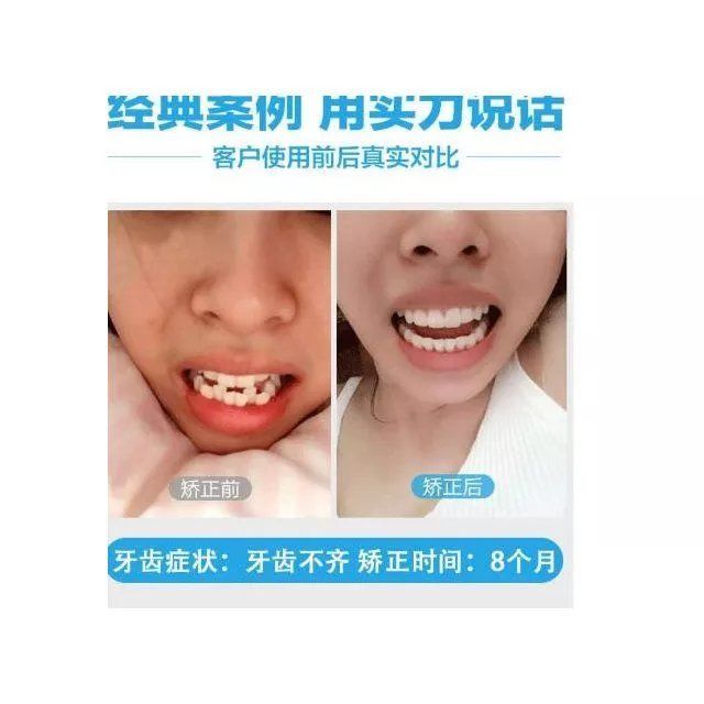 牙套泡腾地包天牙齿矫康护堂牙齿矫正器正器钢丝牙套安装工具牙套